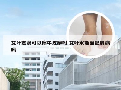 艾叶煮水可以擦牛皮癣吗 艾叶水能治银屑病吗