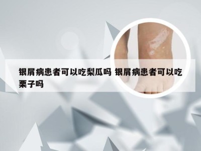 银屑病患者可以吃梨瓜吗 银屑病患者可以吃栗子吗