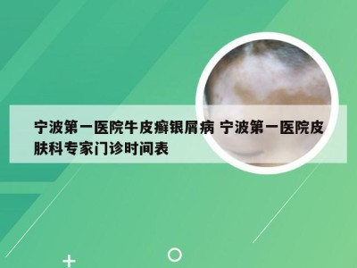 宁波第一医院牛皮癣银屑病 宁波第一医院皮肤科专家门诊时间表