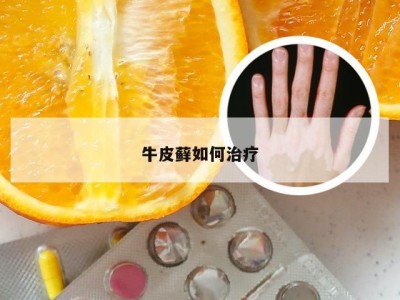 牛皮藓如何治疗