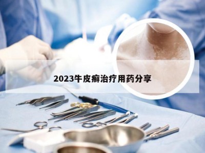 2023牛皮癣治疗用药分享