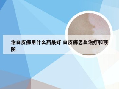 治白皮癣用什么药最好 白皮癣怎么治疗和预防