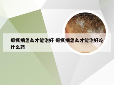 癫疯病怎么才能治好 癫疯病怎么才能治好吃什么药