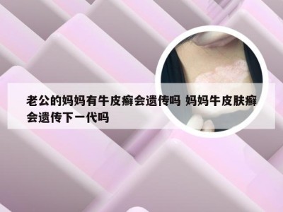 老公的妈妈有牛皮癣会遗传吗 妈妈牛皮肤癣会遗传下一代吗