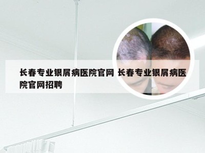 长春专业银屑病医院官网 长春专业银屑病医院官网招聘