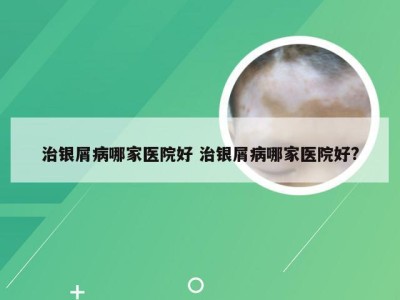 治银屑病哪家医院好 治银屑病哪家医院好?