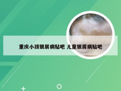 重庆小孩银屑病贴吧 儿童银屑病贴吧