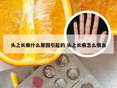 头上长癣什么原因引起的 头上长癣怎么根治