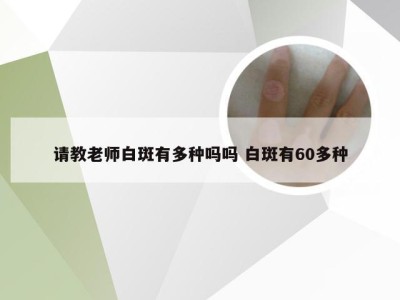 请教老师白斑有多种吗吗 白斑有60多种