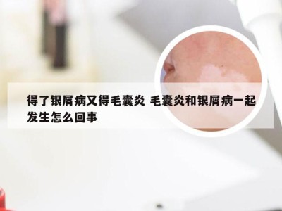 得了银屑病又得毛囊炎 毛囊炎和银屑病一起发生怎么回事