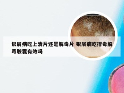 银屑病吃上清片还是解毒片 银屑病吃排毒解毒胶囊有效吗