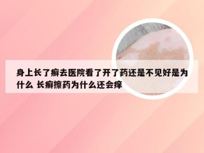 身上长了癣去医院看了开了药还是不见好是为什么 长癣擦药为什么还会痒