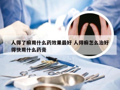 人得了癣用什么药效果最好 人得癣怎么治好得快用什么药膏