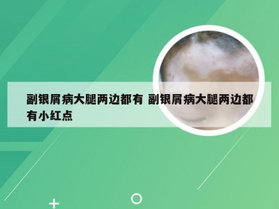 副银屑病大腿两边都有 副银屑病大腿两边都有小红点