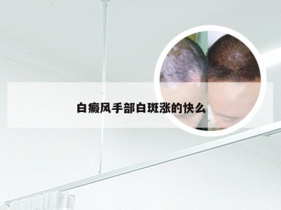 白癜风手部白斑涨的快么