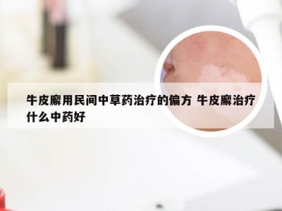 牛皮廨用民间中草药治疗的偏方 牛皮廨治疗什么中药好