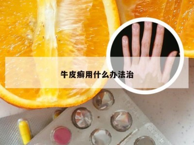 牛皮癣用什么办法治