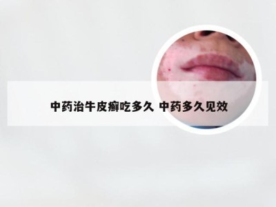 中药治牛皮癣吃多久 中药多久见效