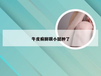 牛皮癣脚跟小腿肿了