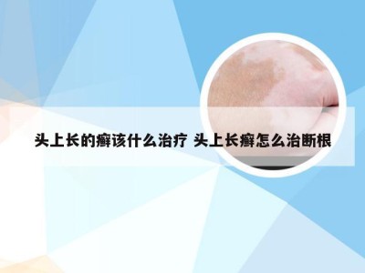 头上长的癣该什么治疗 头上长癣怎么治断根