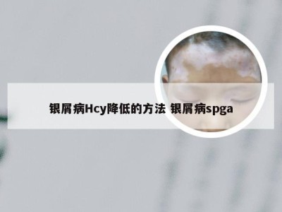 银屑病Hcy降低的方法 银屑病spga