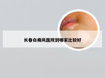 长春白癜风医院到哪家比较好