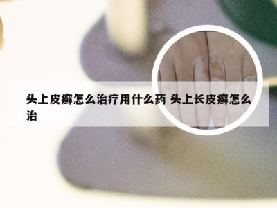 头上皮癣怎么治疗用什么药 头上长皮癣怎么治