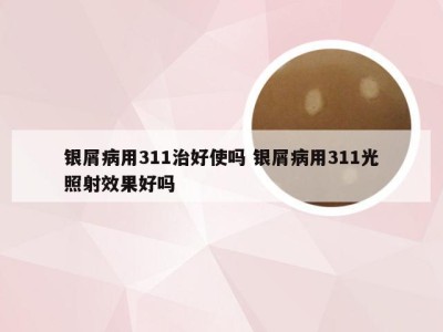 银屑病用311治好使吗 银屑病用311光照射效果好吗