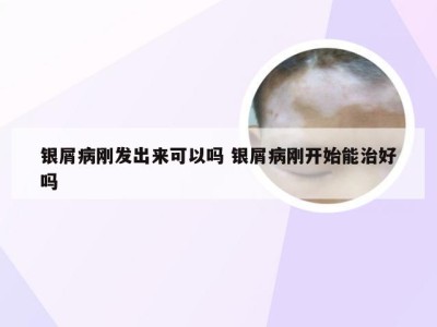 银屑病刚发出来可以吗 银屑病刚开始能治好吗