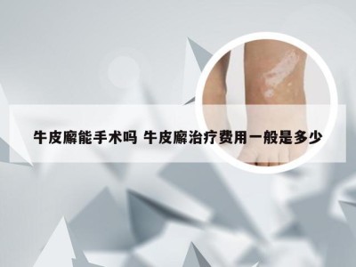 牛皮廨能手术吗 牛皮廨治疗费用一般是多少