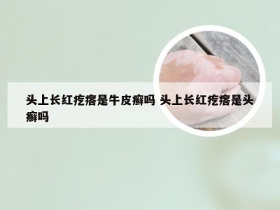 头上长红疙瘩是牛皮癣吗 头上长红疙瘩是头癣吗