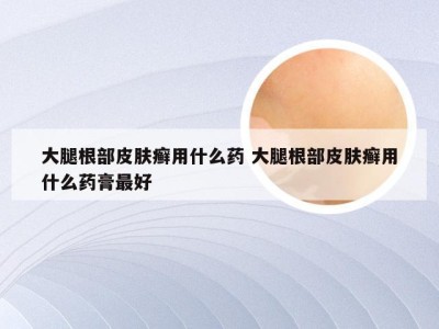 大腿根部皮肤癣用什么药 大腿根部皮肤癣用什么药膏最好