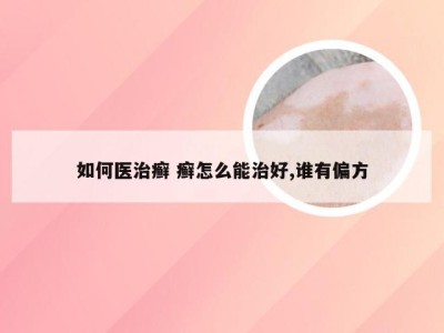 如何医治癣 癣怎么能治好,谁有偏方