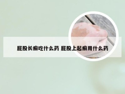 屁股长癣吃什么药 屁股上起癣用什么药