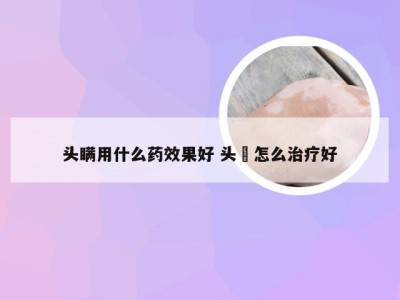 头瞒用什么药效果好 头廯怎么治疗好