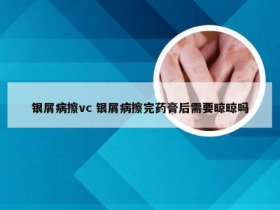 银屑病擦vc 银屑病擦完药膏后需要晾晾吗