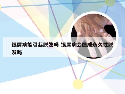 银屑病能引起脱发吗 银屑病会造成永久性脱发吗