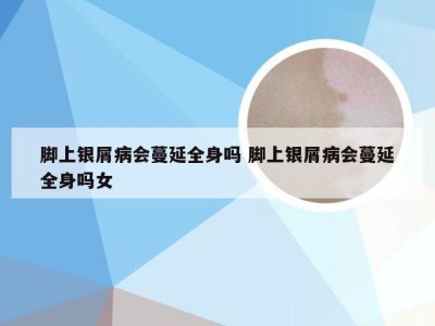 脚上银屑病会蔓延全身吗 脚上银屑病会蔓延全身吗女