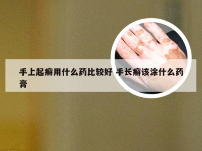 手上起癣用什么药比较好 手长癣该涂什么药膏