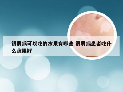 银屑病可以吃的水果有哪些 银屑病患者吃什么水果好