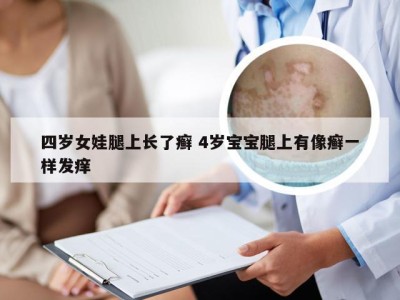 四岁女娃腿上长了癣 4岁宝宝腿上有像癣一样发痒