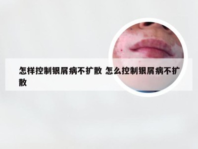 怎样控制银屑病不扩散 怎么控制银屑病不扩散