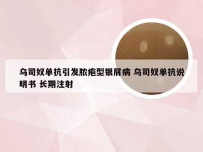 乌司奴单抗引发脓疱型银屑病 乌司奴单抗说明书 长期注射