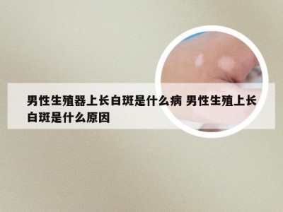 男性生殖器上长白斑是什么病 男性生殖上长白斑是什么原因