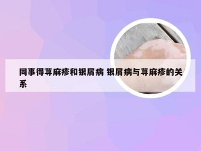 同事得荨麻疹和银屑病 银屑病与荨麻疹的关系