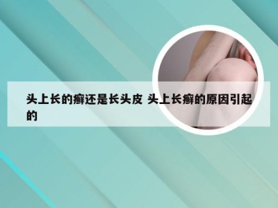 头上长的癣还是长头皮 头上长癣的原因引起的