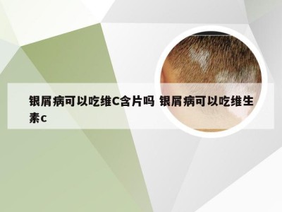 银屑病可以吃维C含片吗 银屑病可以吃维生素c