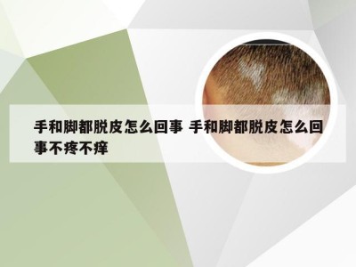 手和脚都脱皮怎么回事 手和脚都脱皮怎么回事不疼不痒