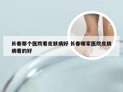 长春那个医院看皮肤病好 长春哪家医院皮肤病看的好