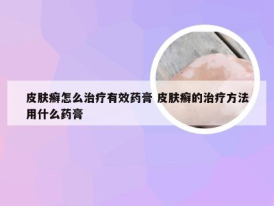 皮肤癣怎么治疗有效药膏 皮肤癣的治疗方法用什么药膏